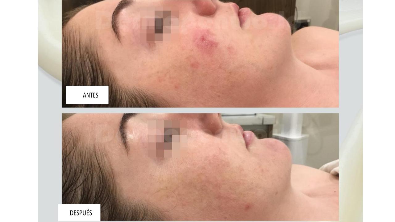 Dermapen 1