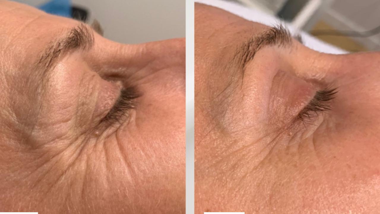 Dermapen 2