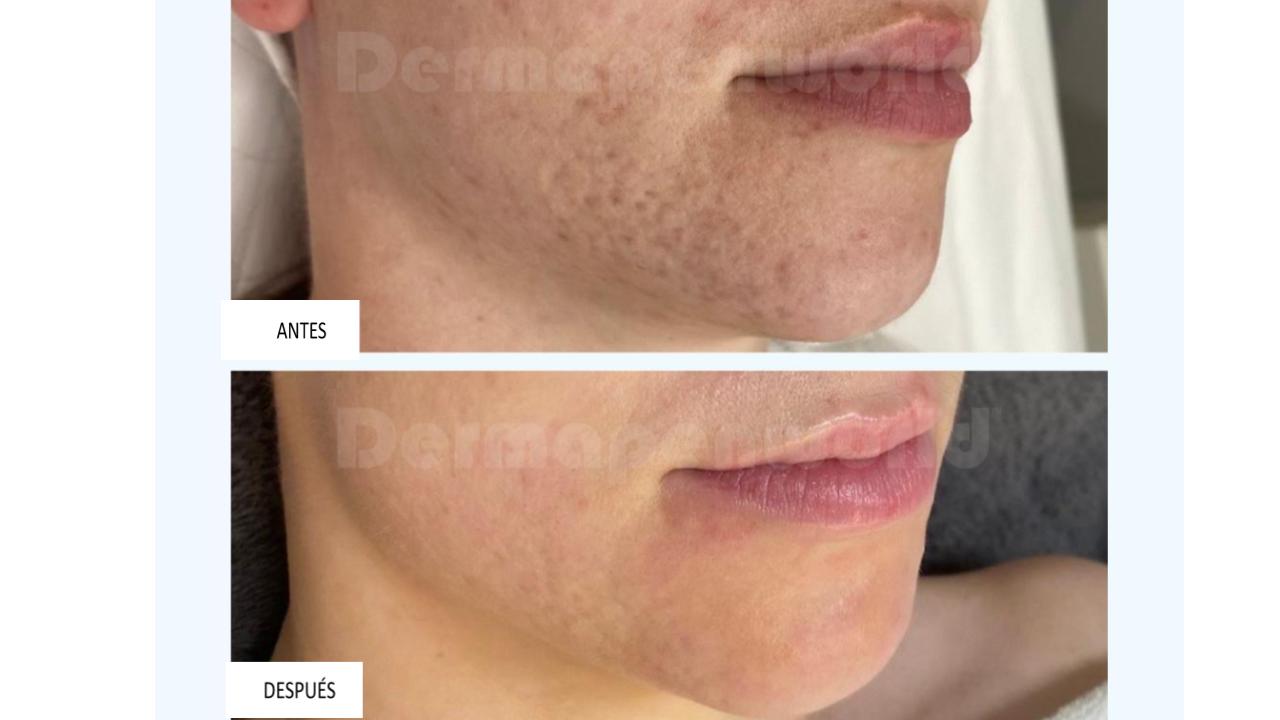 Dermapen 3