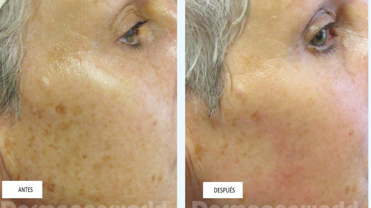 Dermapen 5