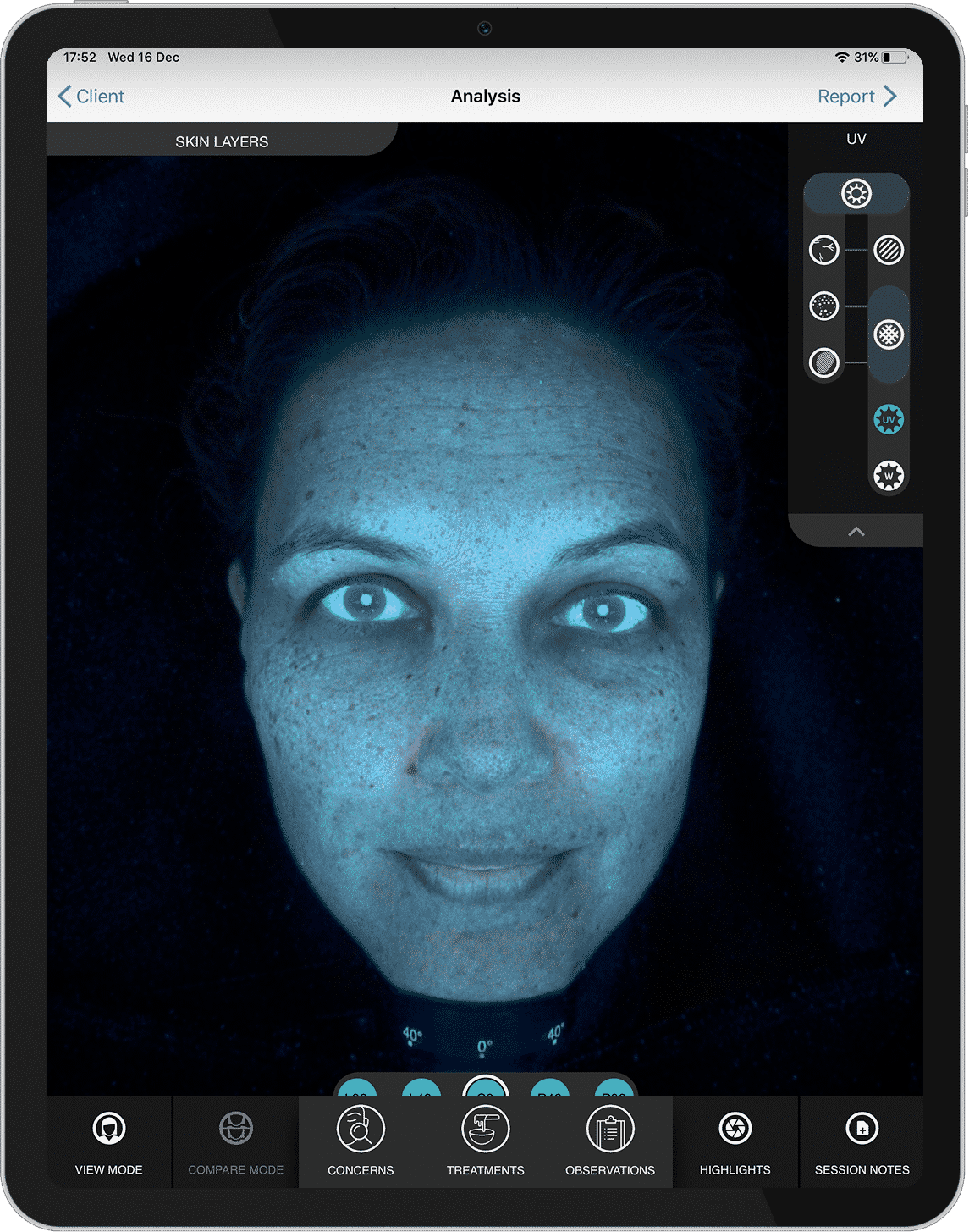 Análisis de piel con luz UV en OBSERV 520x