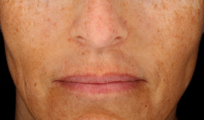 Antes del tratamiento Cosmelan para manchas y melasma en Málaga - caso 1