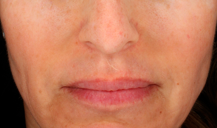 Después del tratamiento Cosmelan para manchas y melasma en Málaga - caso 1