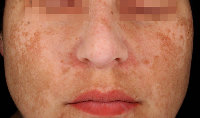 Antes del tratamiento Cosmelan para manchas y melasma en Málaga - caso 2