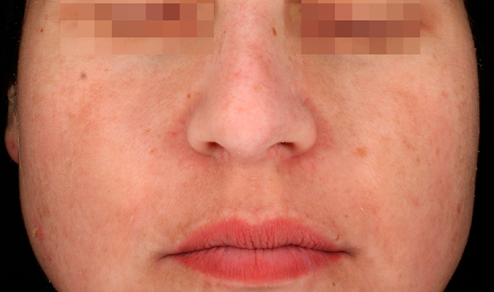 Después del tratamiento Cosmelan para manchas y melasma en Málaga - caso 2