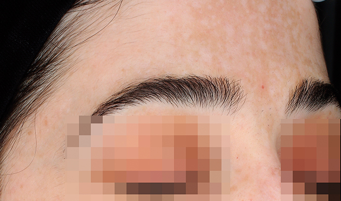 Antes del tratamiento Cosmelan para manchas y melasma en Málaga - caso 3