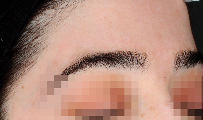 Después del tratamiento Cosmelan para manchas y melasma en Málaga - caso 3