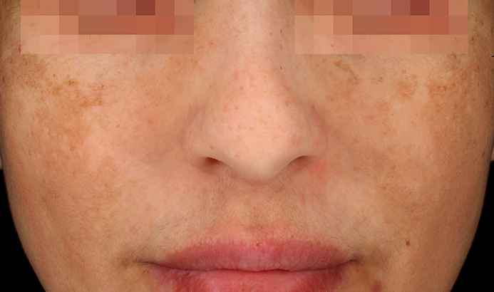 Antes del tratamiento Cosmelan para manchas y melasma en Málaga - caso 4