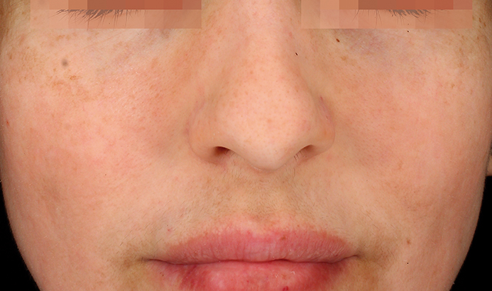 Después del tratamiento Cosmelan para manchas y melasma en Málaga - caso 4
