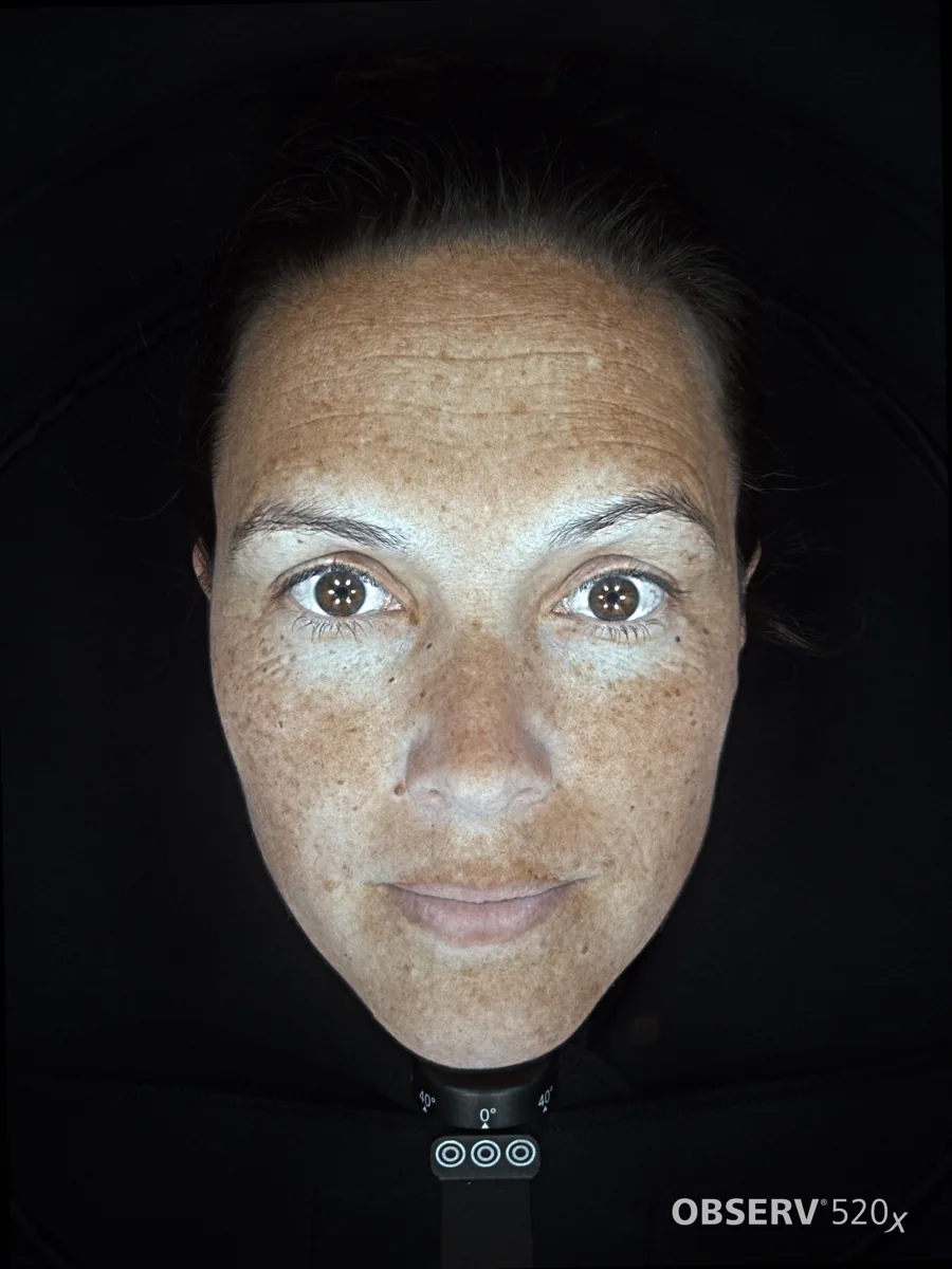 Manchas y fotoenvejecimiento revelados