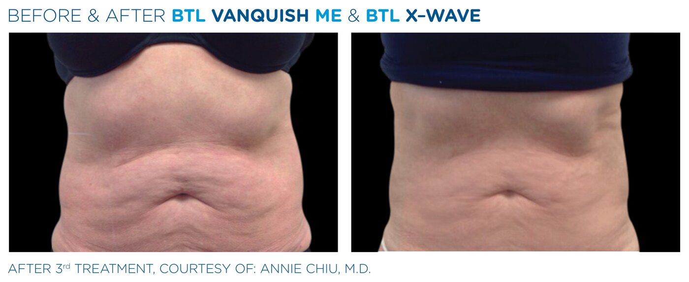 Antes y después de Ondas de Choque BTL X-Wave en abdomen - Clínica Marchesi Málaga