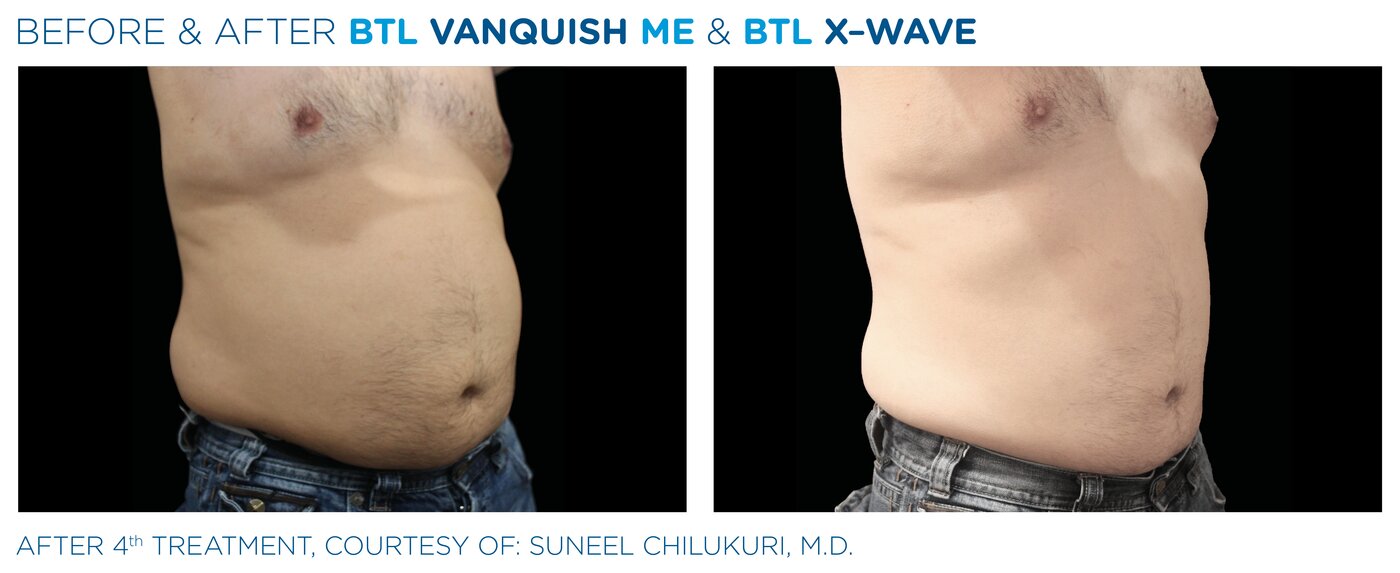 Resultado de Ondas de Choque BTL X-Wave en abdomen masculino - Clínica Marchesi Málaga