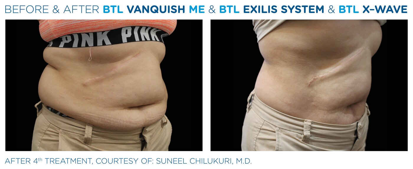 Antes y después del protocolo Body by BTL (Vanquish ME + Exilis + X-Wave) en abdomen - Clínica Marchesi Málaga