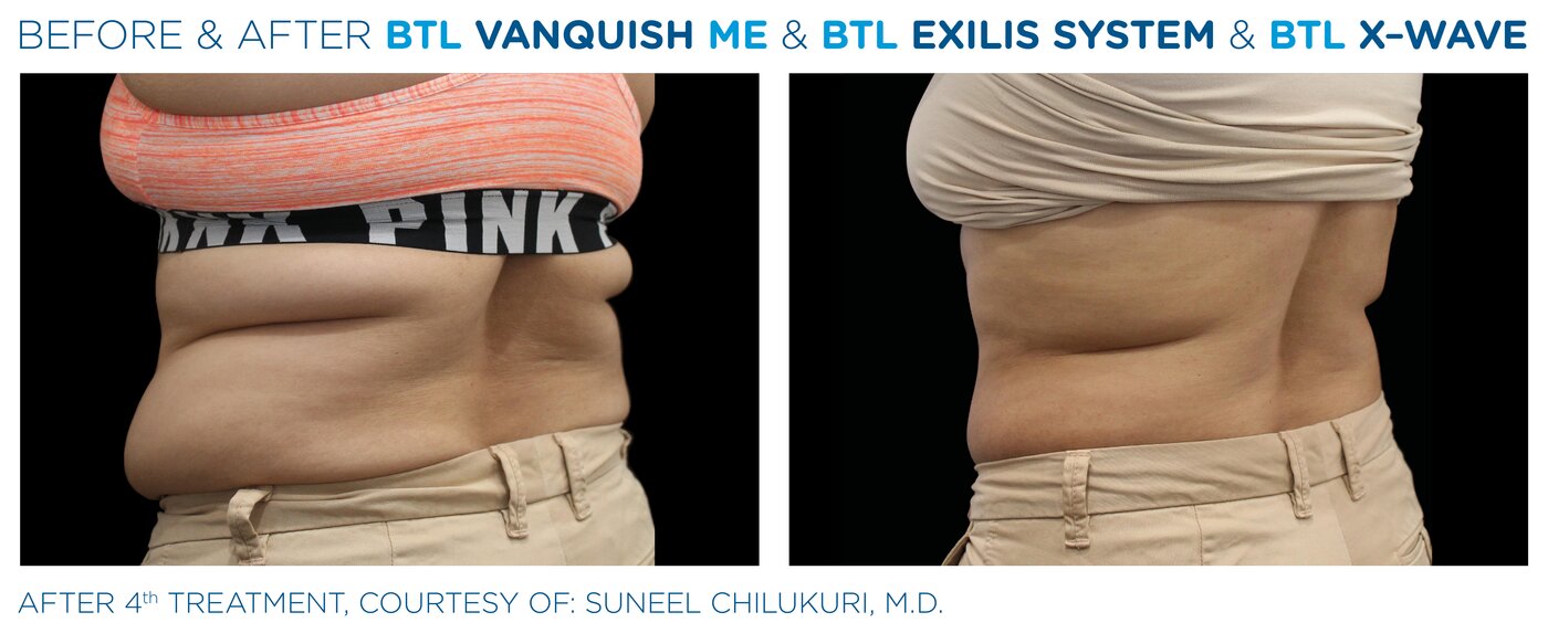 Resultado del protocolo Body by BTL (Vanquish ME + Exilis + X-Wave) en abdomen, vista lateral - Clínica Marchesi Málaga